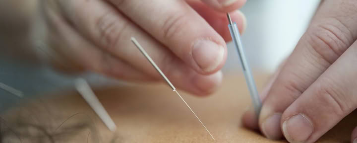 $95 Eerste bezoek - acupunctuursessie